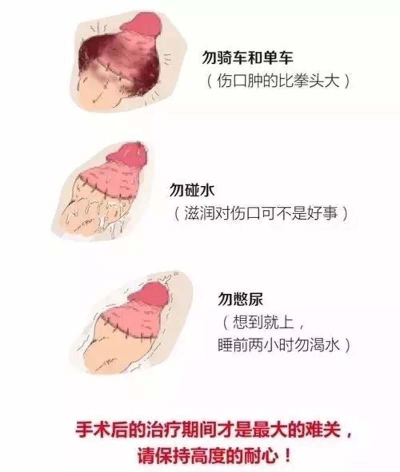 如何从身边的小信号辨别泌尿系结石？